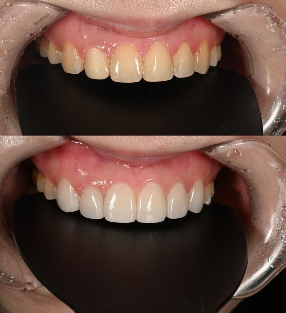 Tooth color, case 1: before and after