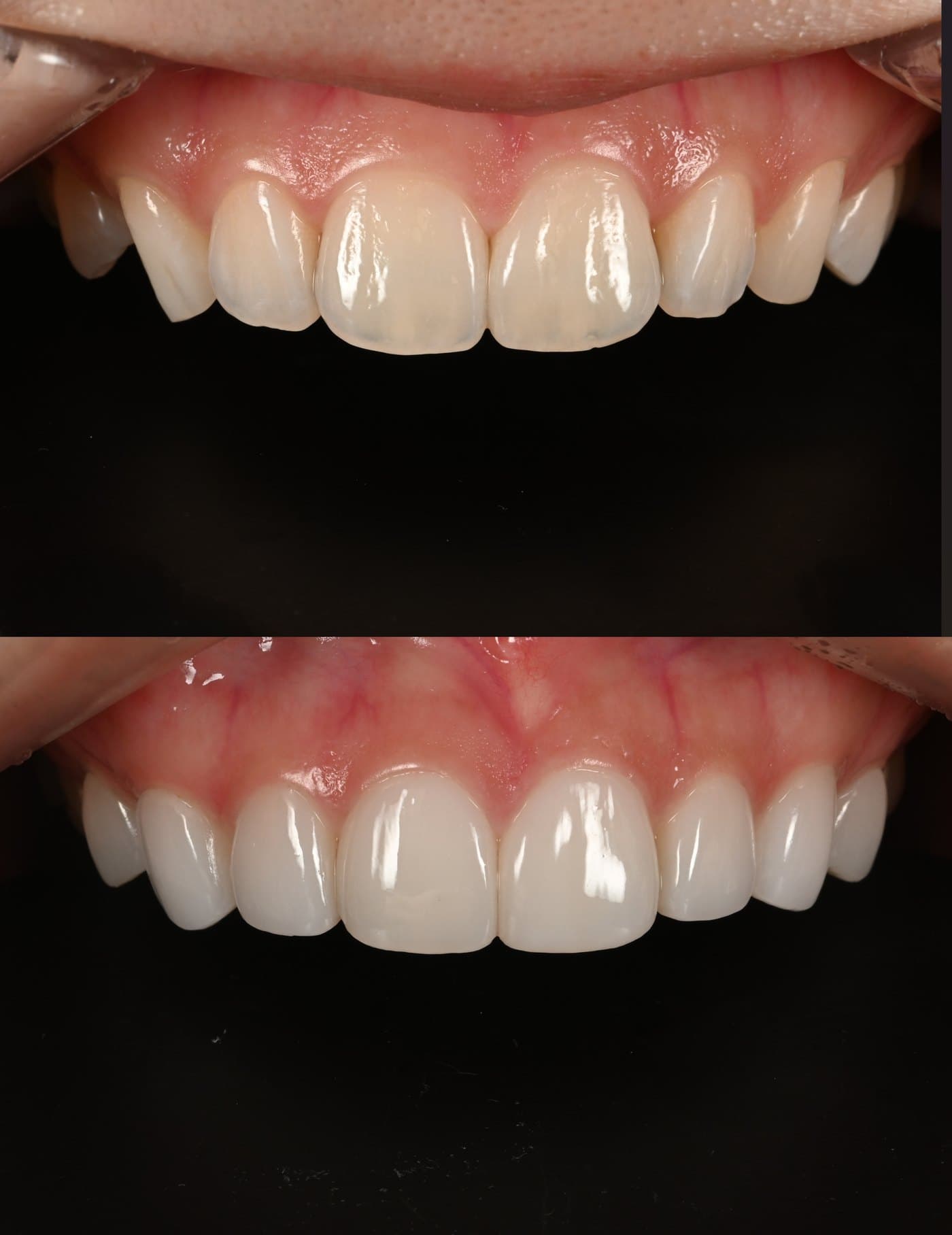 Tooth color, case 2: before and after