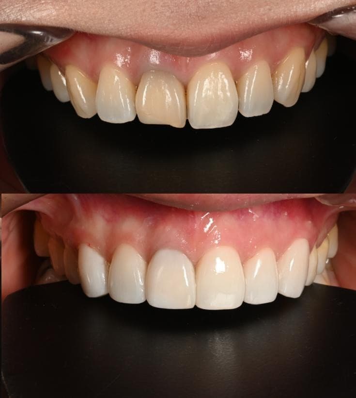 Tooth color, case 3: before and after